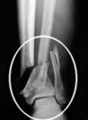 broken bone